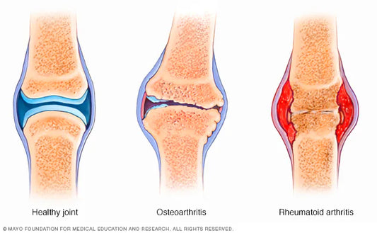 Grounding and Arthritis: Exploring Natural Approaches to Support Comfort and Inflammation Management