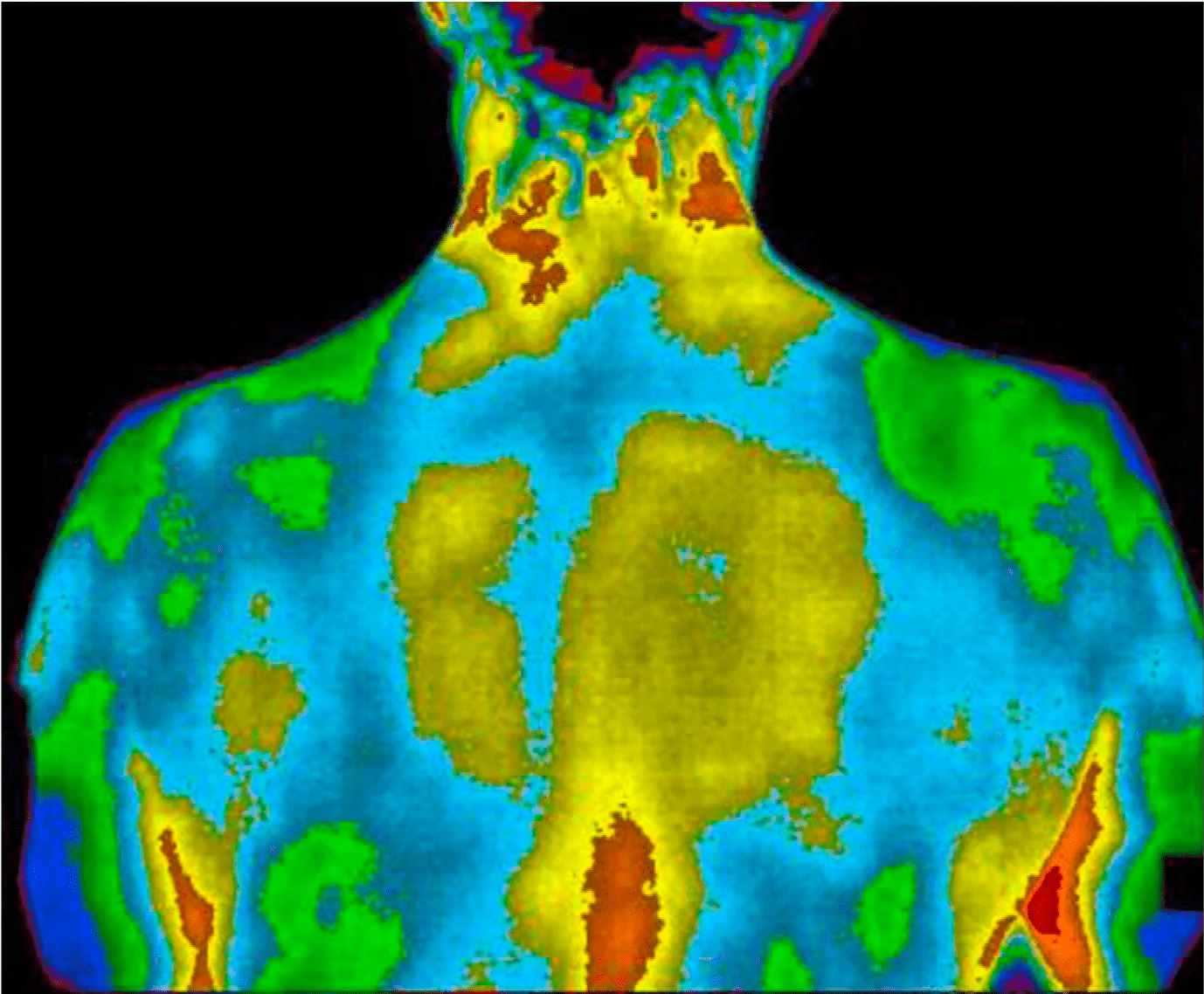 Thermische Bildgebung des Rückens einer Person mit Farbcode, der Temperaturunterschiede und geringe Entzündungen anzeigt