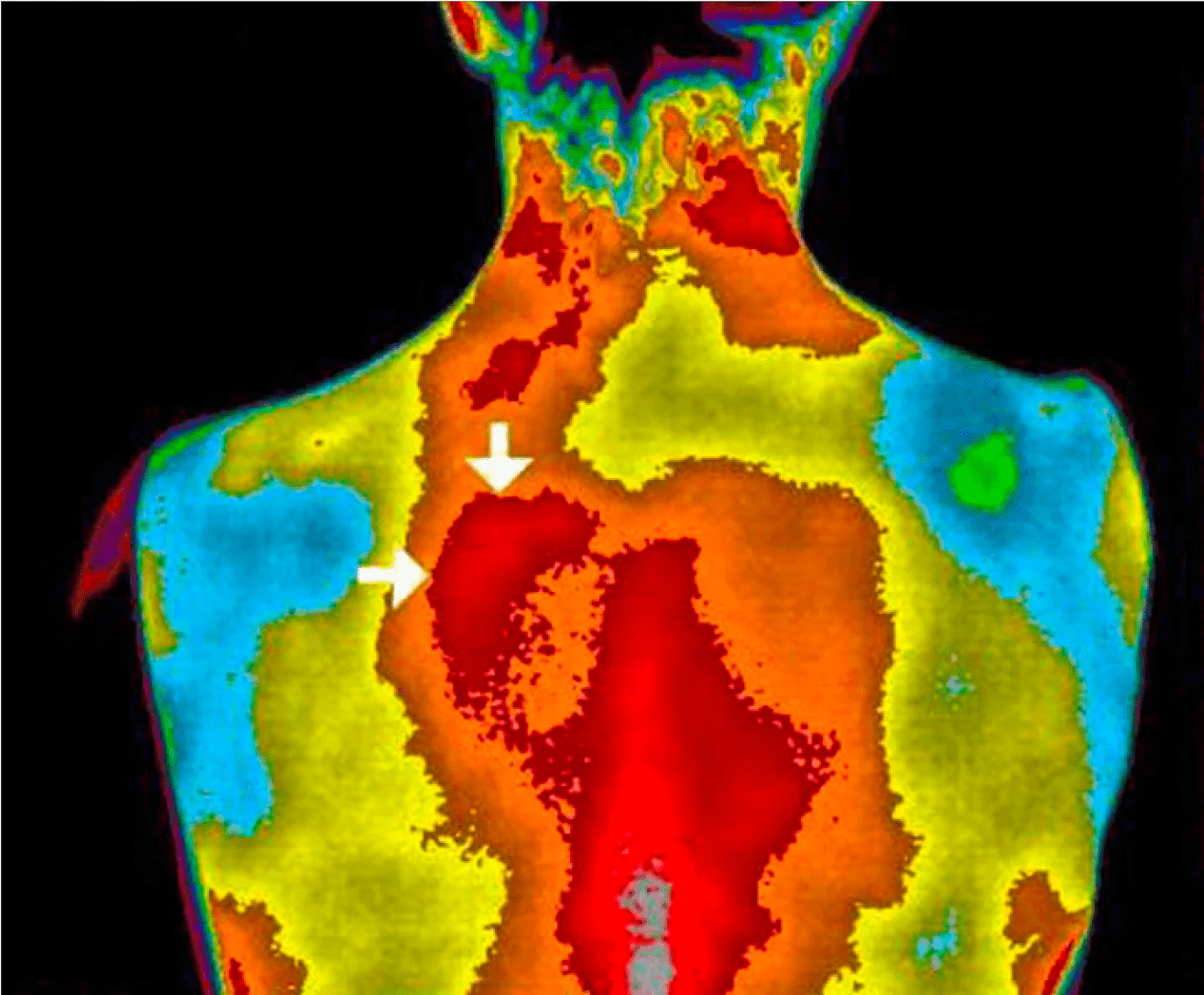 Thermische Bildgebung des Rückens einer Person mit Farbcode, der Temperaturunterschiede und hohe Entzündungen anzeigt